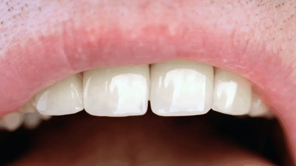 Widok z bliska otwartych ust osoby, podkreślający czyste, białe górne przednie zęby i część różowej górnej wargi, oferujący szczegółowe spojrzenie na budowę zęba.