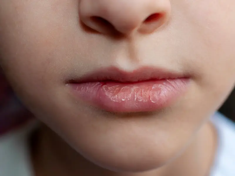Zbliżenie twarzy osoby, skupiające się na ustach z suchymi, spierzchniętymi wargami - efekt suchości w ustach - oraz gładkiej skórze wokół ust i nosa.