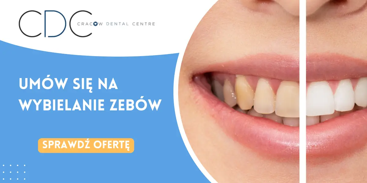 Wybielanie zębów baner