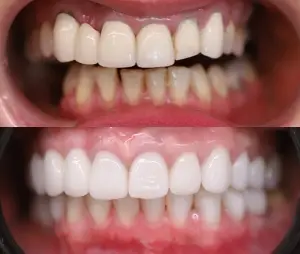 Dwa zbliżenia zębów osoby; górne pokazuje przebarwione, nierówne zęby, podczas gdy dolne pokazuje proste, równomiernie zabarwione zęby - imponująca transformacja prawdopodobnie osiągnięta w gabinecie stomatologicznym.