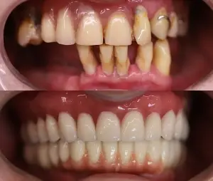 Dwa zbliżenia zębów: górne pokazuje pożółkłe, źle ustawione i zepsute zęby; dolne pokazuje proste, białe, zdrowo wyglądające zęby, ilustrujące dramatyczną transformację stomatologiczną.