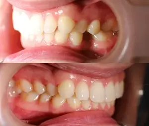 Dwa zdjęcia obok siebie przedstawiające zęby przed i po leczeniu ortodontycznym przeprowadzonym przez doświadczonego stomatologa; górne zdjęcie przedstawia stłoczone, źle ustawione zęby, podczas gdy dolne zdjęcie pokazuje wyprostowane, prawidłowo ustawione wyniki.