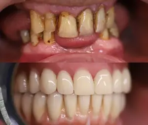 Porównanie zębów w zbliżeniu przed i po leczeniu stomatologicznym; górna część przedstawia przebarwione, źle ustawione zęby, podczas gdy dolna część przedstawia czyste, proste, białe zęby.