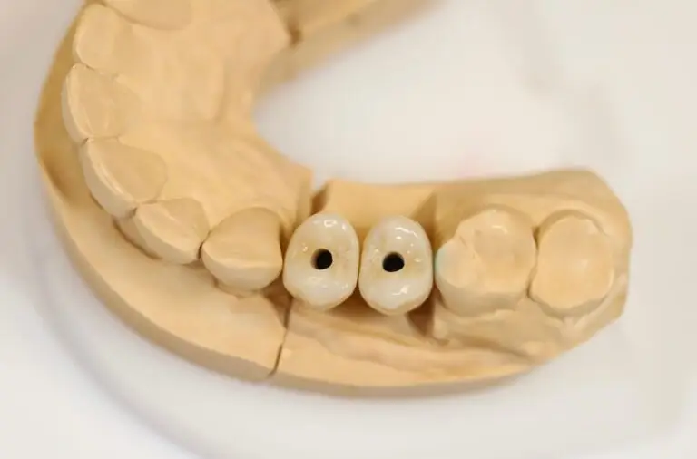 Zbliżenie formy dentystycznej przedstawiającej dwie znajdujące się obok siebie korony dentystyczne z otworami pośrodku, reprezentujące model uzupełnień dentystycznych wspartych na implantach, stosowanych w protetyce.