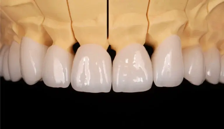 Zbliżenie na licówki dentystyczne na modelu gipsowym, przedstawiające protetyka z jasnobiałymi sztucznymi zębami na delikatnym beżowym tle.